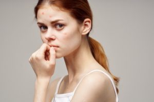 woman with acne