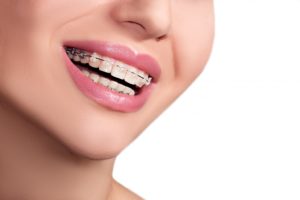 Female with braces