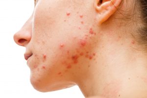 woman with acne