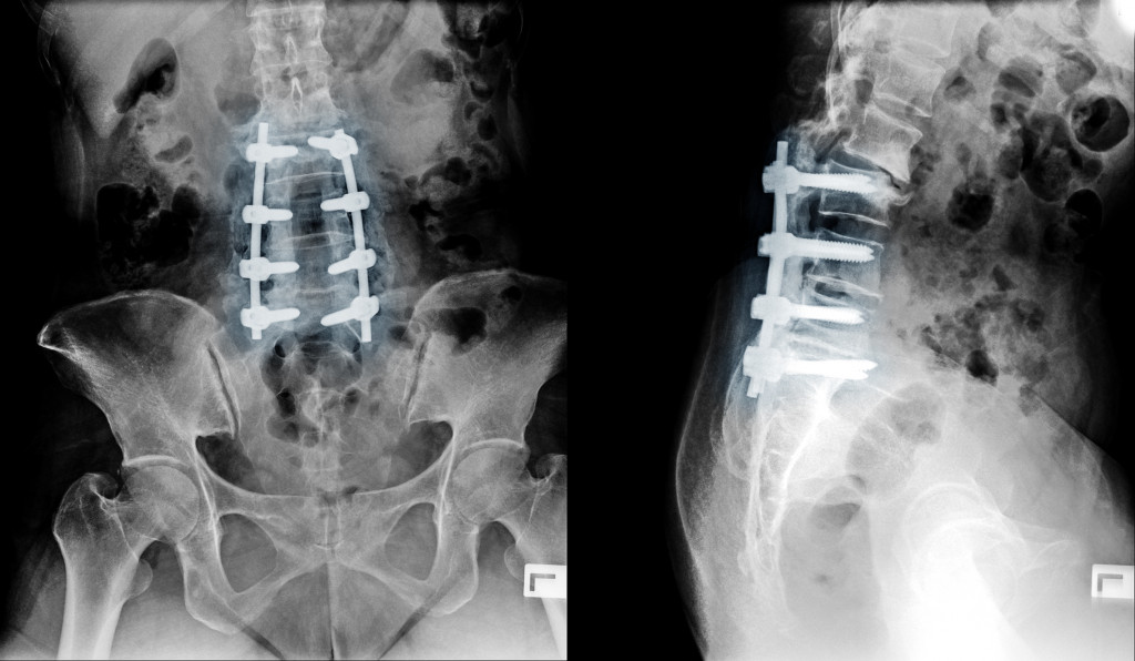 an X-ray of a joint in the back of the neck